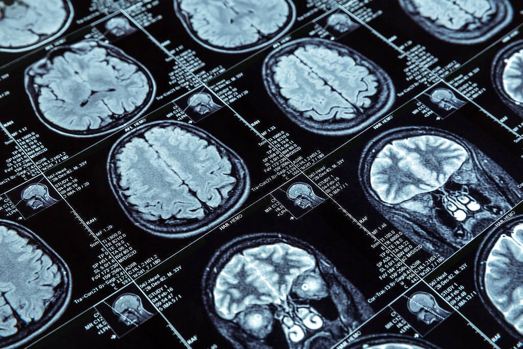 remedios-para-alzheimer-nao-mostram-efeito-clinicamente-relevante,-diz-revisao