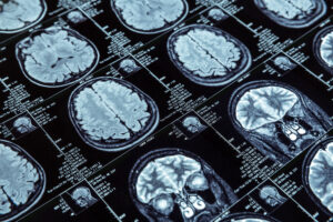 pesquisadores-desenvolvem-metodo-para-prever-alzheimer-antes-dos-primeiros-sinais