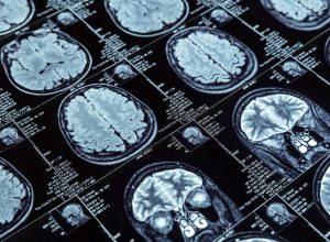 remedios-para-alzheimer-nao-mostram-efeito-clinicamente-relevante,-diz-revisao