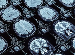pesquisadores-desenvolvem-metodo-para-prever-alzheimer-antes-dos-primeiros-sinais